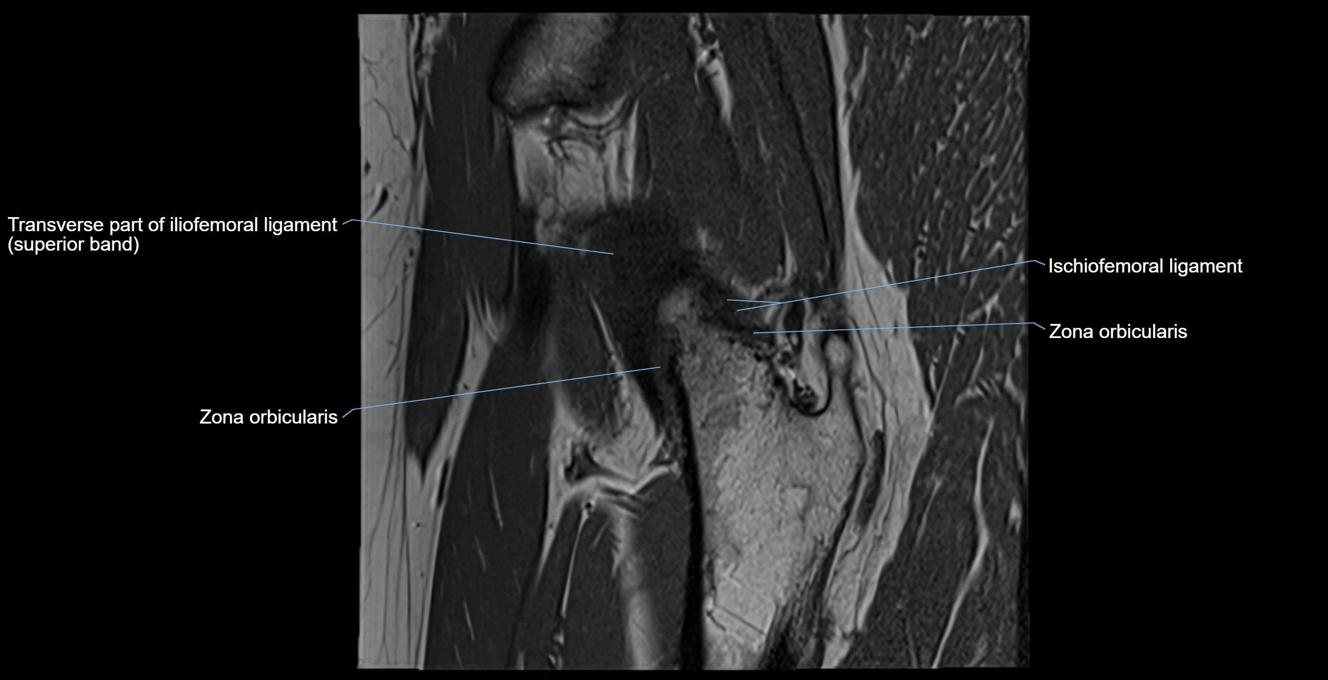 MRI Hip ligaments sagittal cross sectional anatomy 3T  radiology  image-img-00001-00017.webp
